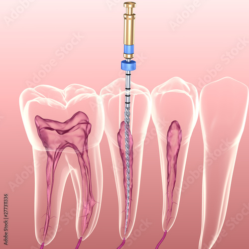 Fototapeta Naklejka Na Ścianę i Meble -  Endodontic root canal treatment process. Medically accurate tooth 3D illustration.