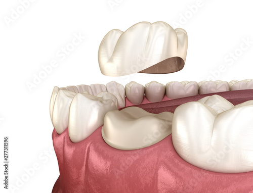 Preparated molar tooth for dental crown placement. Medically accurate 3D illustration