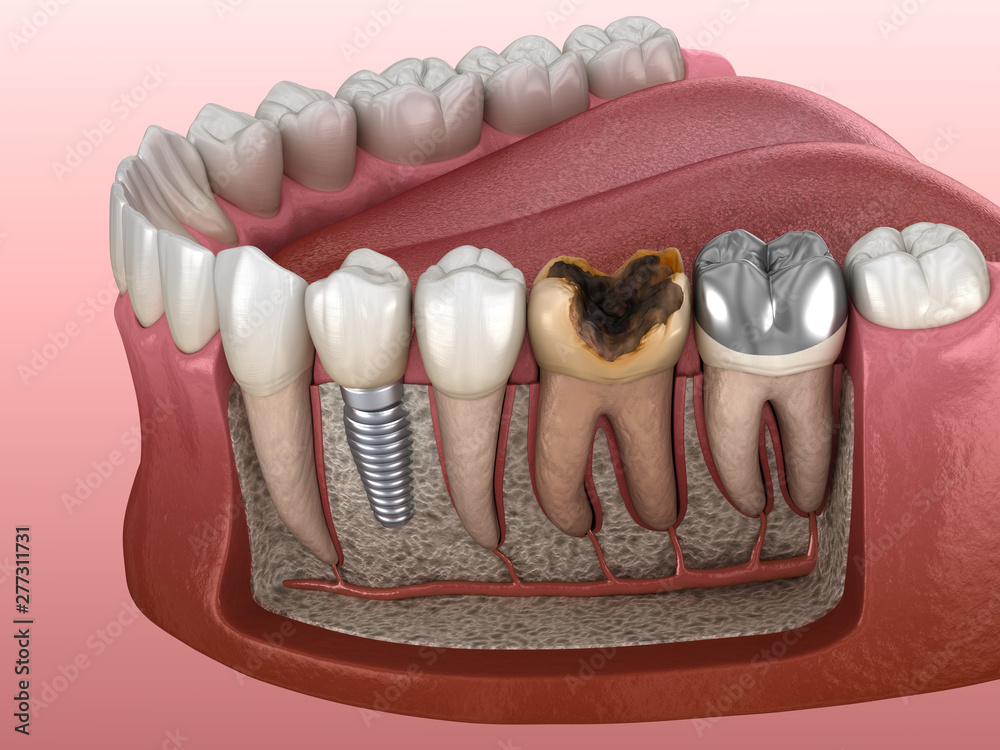 Premolar tooth crown installation over implant abutment, damaged molar and silver  crown.3D illustration of dental concept Stock Illustration | Adobe Stock