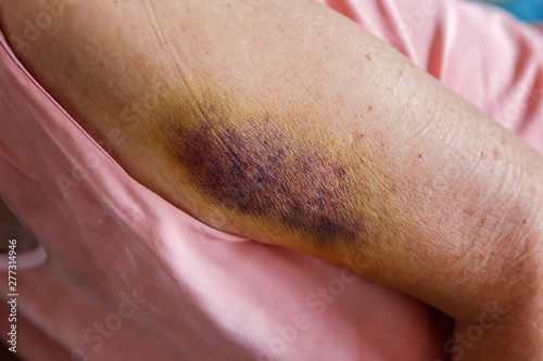 Wallpaper Mural Large dark bruises  or hematoma on arm of an elderly person. Painful accident. Torontodigital.ca