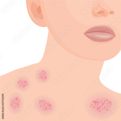 Eczema affected a body 