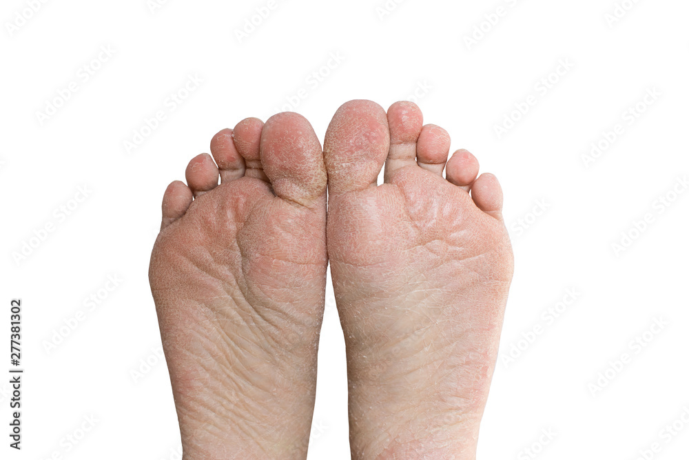 Close up cracked heels. Health problems with skin on feet Close up cracked heels. Health problems with skin on feet
