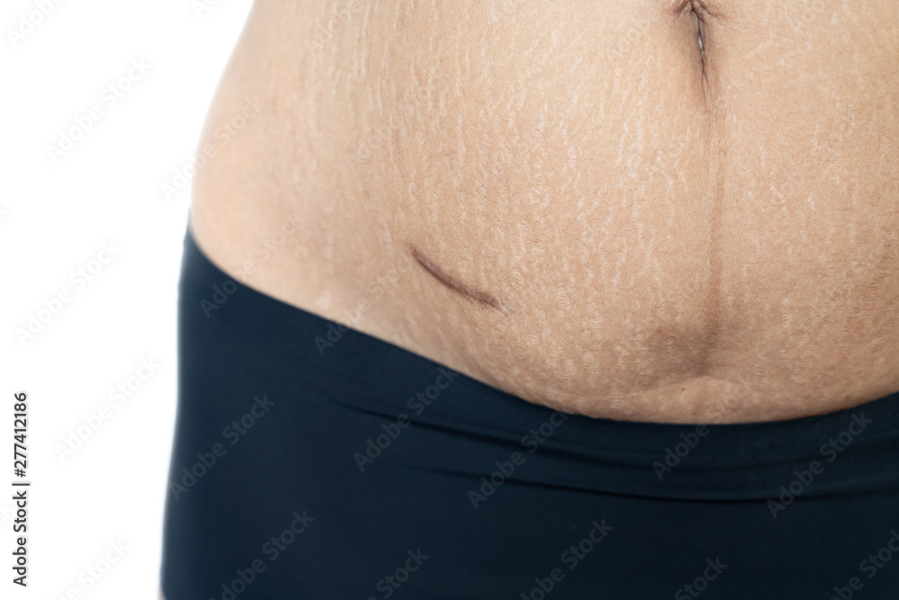 Foto Stock Fat belly scratch mark pregnancy female Skin surgical operation  remove appendix scar | Adobe Stock