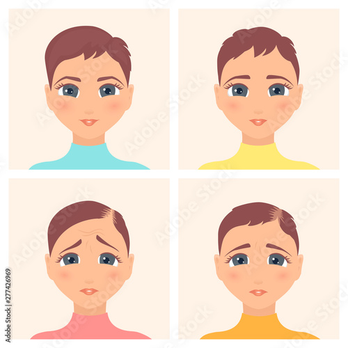 Hair loss stages set of four steps. Front view of a woman losing hair. Female alopecia pattern. Medical infographics. Health and beauty concept. Vector illustration made in cartoon style.