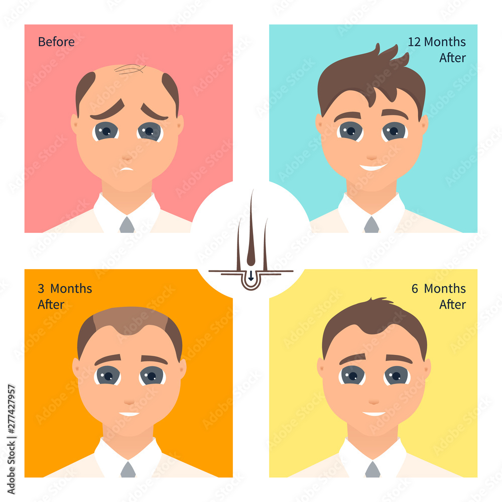 Hair transplantation surgery post operative result infographics. Man  patient before and after procedure. Male hair loss treatment with FUT, FUE  method. Alopecia medical design poster. Stock Vector | Adobe Stock