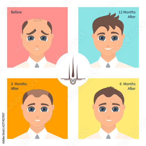 Hair transplantation surgery post operative result infographics. Man patient before and after procedure. Male hair loss treatment with FUT, FUE method. Alopecia medical design poster.
