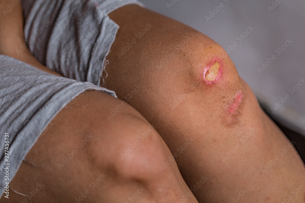 Women injury - painful knee wound accident - Bruised wound injury on woman knee - Medical and health conditions Women injury - painful knee wound accident - Bruised wound injury on woman knee - Medical and health conditions