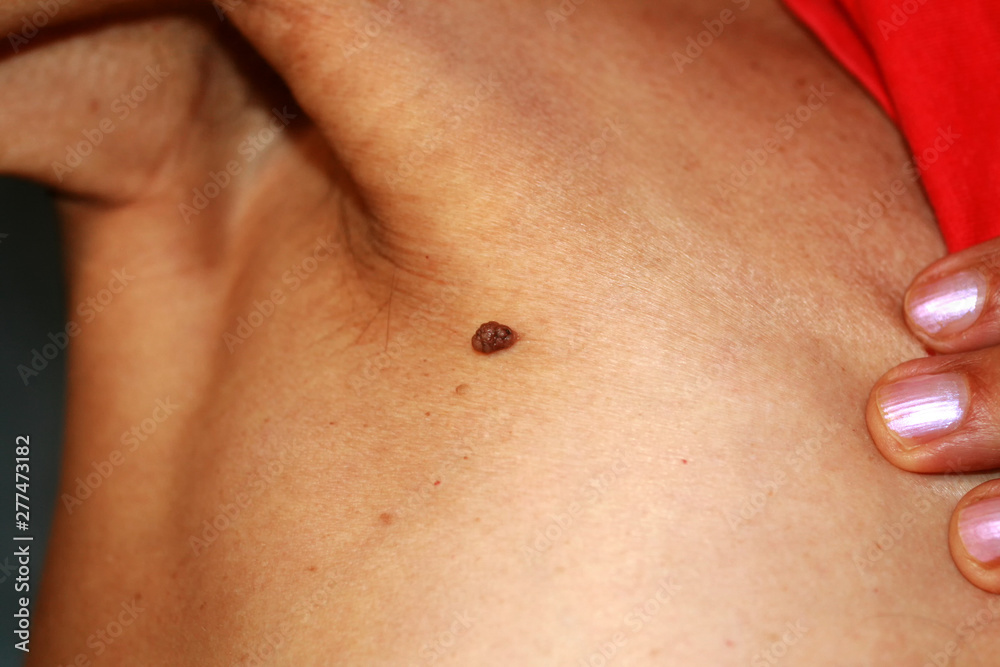 Birthmark of the armpit. Popiloma is large. Birthmark of the armpit. Popiloma is large.