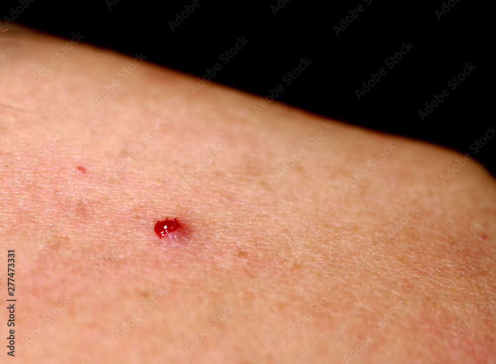 Torn off a bleeding pimple on the skin. Inflammation, acne. Stock Photo