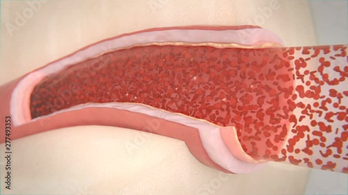 Artery Clogging with the Cholesterol Plaque