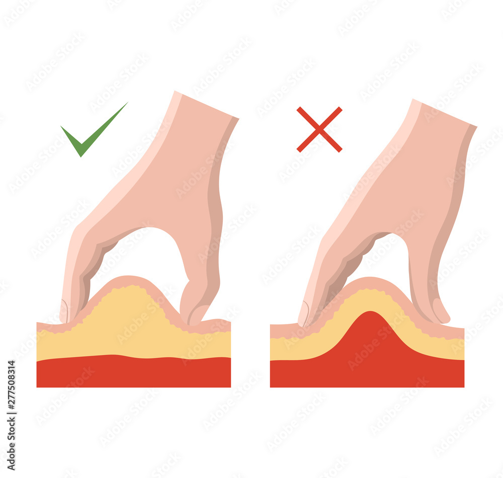Insulin injection technique for diabetes. Correct and incorrect ...