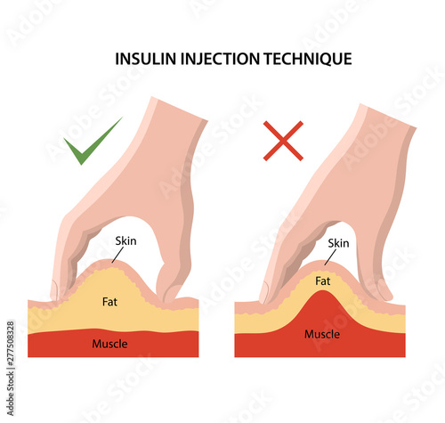Insulin injection technique for diabetes. Correct and incorrect injections are shown. Anatomical vector illustration in flat style isolated over white background.