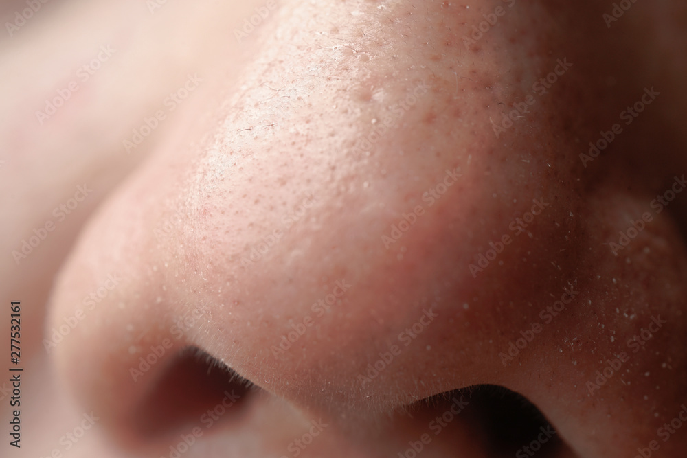 A close up of white head on nose of asian men