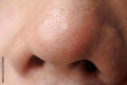 A close up of white head on nose of asian men