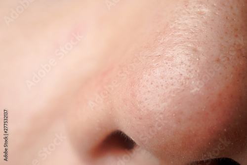 A close up of white head on nose of asian men
