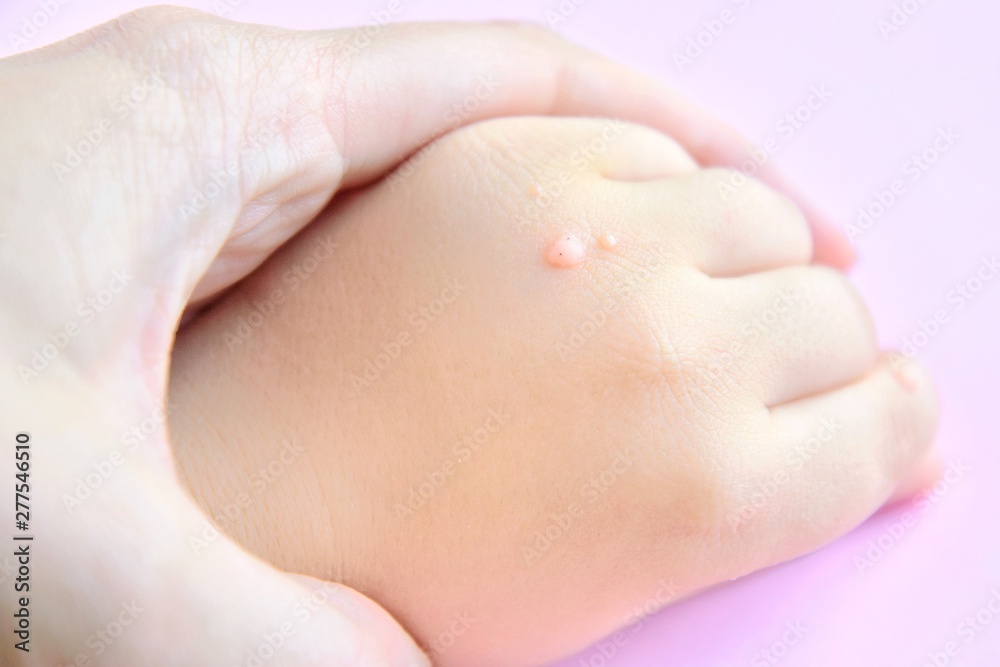 The doctor holds a small hand of a child affected with warts with selective focus on blurred pink background. Papillomavirus in a child's hand and fingers. Pediatric dermatology. Skin diseases The doctor holds a small hand of a child affected with warts with selective focus on blurred pink background. Papillomavirus in a child's hand and fingers. Pediatric dermatology. Skin diseases