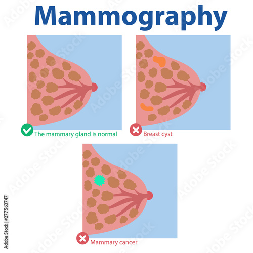 Mammography. The results of the medical examination normal breast, breast cyst, breast cancer. Vector file editable EPS 10