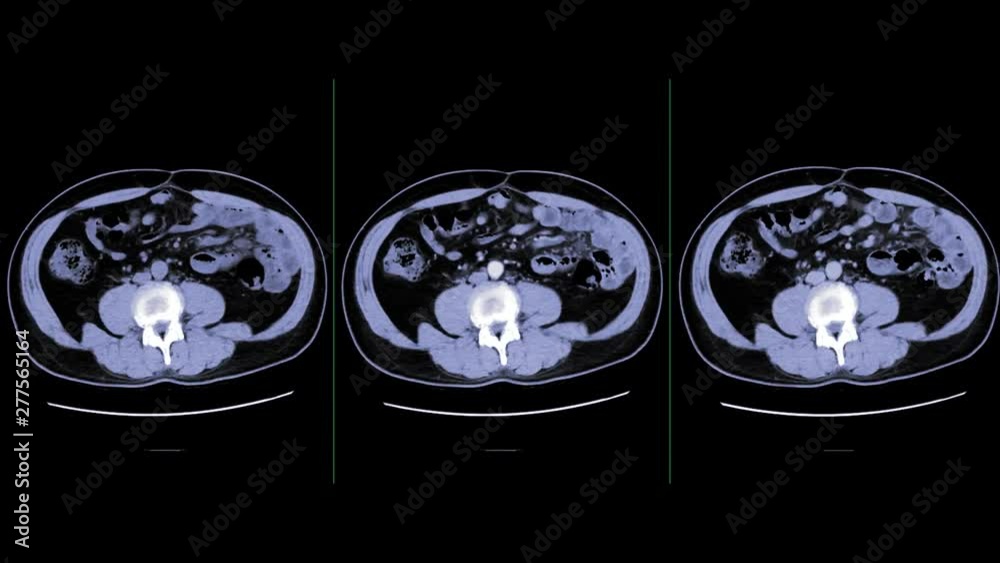 CT whole abdomen Comparison non contrast media, A phase,V phase and ...