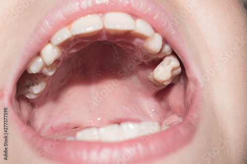 Baby teeth fall out break blacken infected with caries for medicine