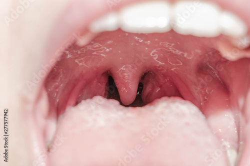 Larynx throat glands tongue viral lingitis inflammation of tonsils mouth for medicine photo