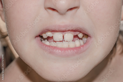 Baby teeth fall out break blacken infected with caries for medicine
