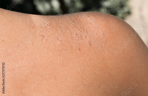 Affected skin of a child's corrosion dry crust flakes for medicine