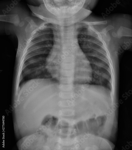 Chest X-ray  image of child