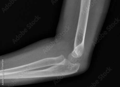  X-ray  human arms broken arm
