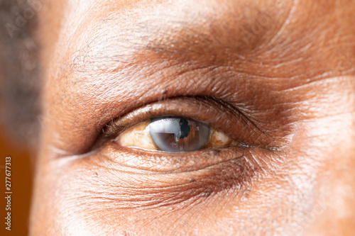 An extreme closeup view on the open eye of an older African man with a cataract. A white cloudy disc is seen in the iris, with room for copy.