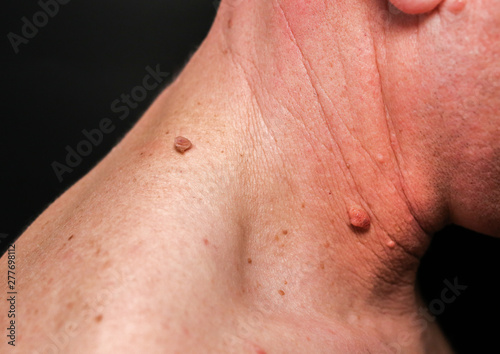 Big birthmark on the man s skin. Medical health photo. Papillomas on the neck.