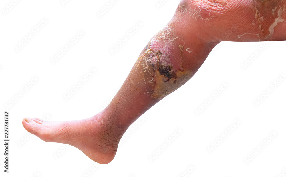 Fototapeta premium Erysipelas bacterial infection Under the skin leg aged people On white background