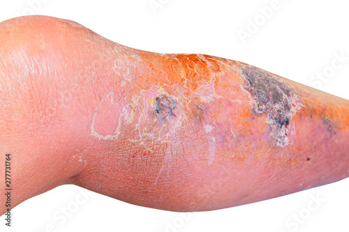 Erysipelas bacterial infection Under the skin leg aged people On  white background photo