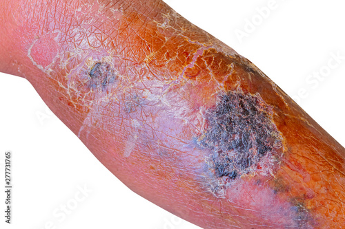 Erysipelas bacterial infection Under the skin leg aged people On  white background