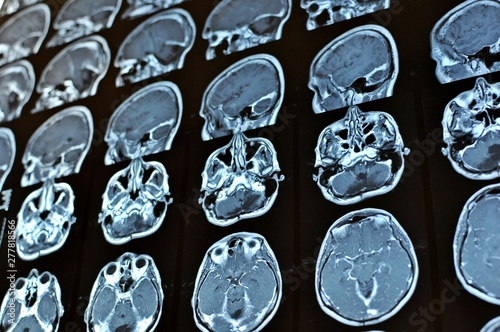 Magnetic resonance image scan of a man brain with a colloid cyst. MRI film of a human skull and brain tumor. Neurology background. Medicine, science.