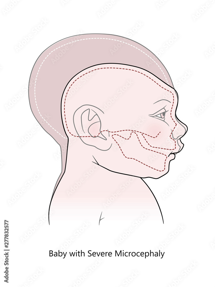 Comparative anatomical image of the head and skull of a newborn child with a normal cranium and severe microcephaly. Virus of Zika. Isolated on white background