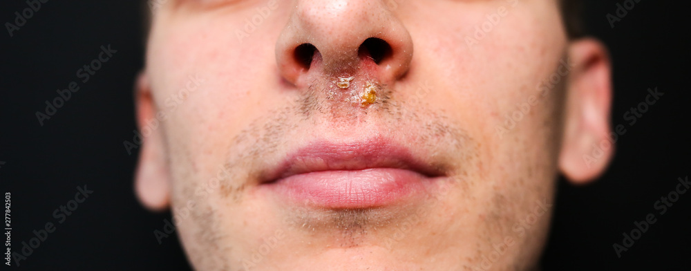 Herpes virus under the nose. Cold sore after the flu. Medical photo. Disease treatment. Herpes virus under the nose. Cold sore after the flu. Medical photo. Disease treatment.