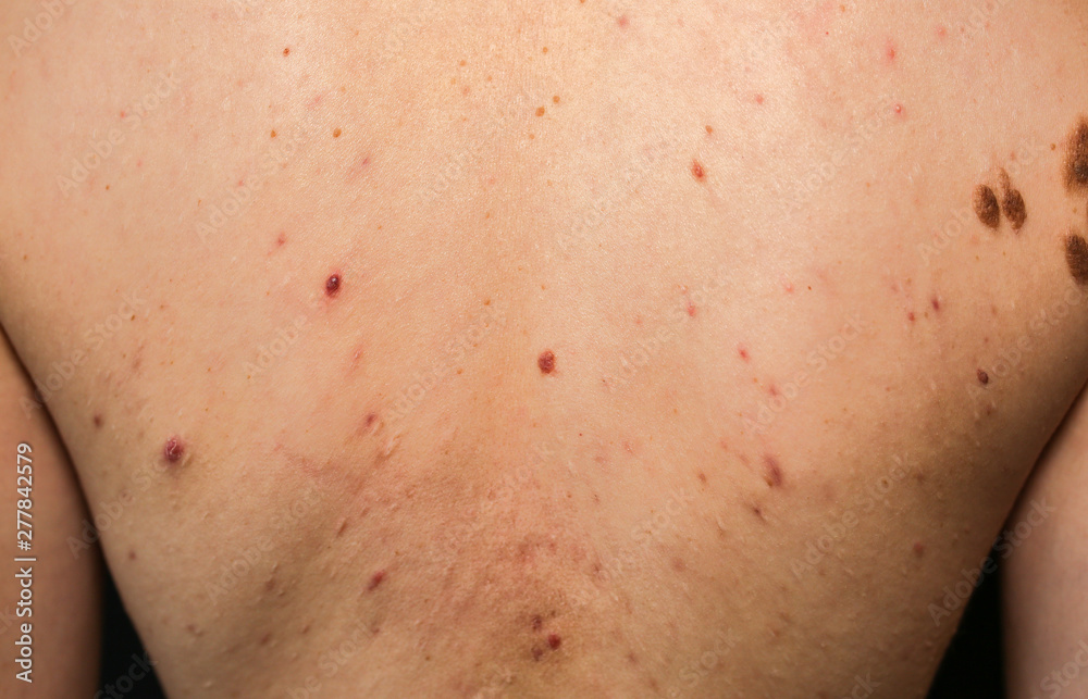 Many birthmarks on the girl's back. Medical health photo. Woman's oily skin with problems acne.