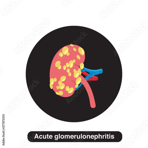acute glomerulonephritis illustration concept