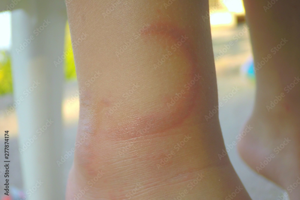 Bite of jellyfish jelly fish marks on a human body child leg Mediterranean  sea Corinth gulf Stock Photo