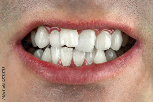 crooked teeth, wrong bite, close-up