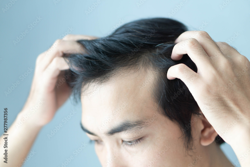 Young man serious hair loss problem for health care medical and shampoo product concept, selective focus Young man serious hair loss problem for health care medical and shampoo product concept, selective focus