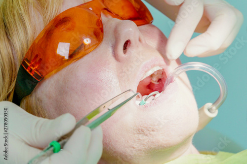 Dentist inserting high volume evacuator suction while saliva ejector is in mouth photo