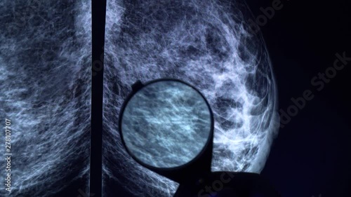 Doctor with magnifying glass checking mammogram x-ray. Mammography diagnostic to prevent breast cancer. 4k close up video photo