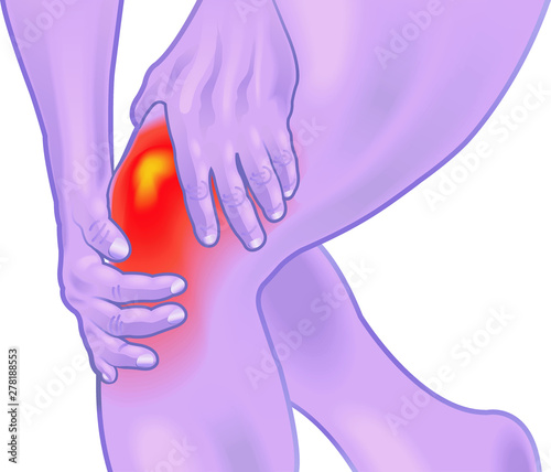 An illustration of a knee with an inflammation of the bursa.