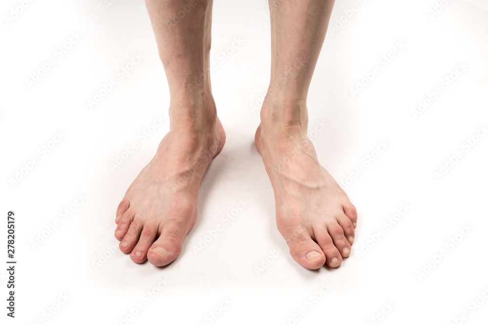 naked legs of a man with varicose veins on a white background naked legs of a man with varicose veins on a white background