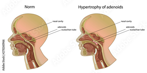 Norm and hypertrophy of adenoids. Location of adenoids.