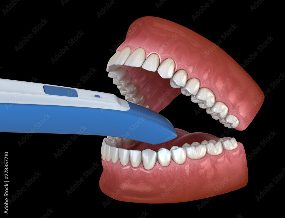 Intraoral Teeth 3D scanner. My own design. 3D illustration concept Intraoral Teeth 3D scanner. My own design. 3D illustration concept
