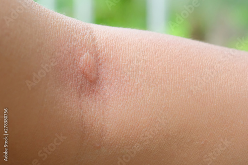 burning skin that rashes from mosquito bites