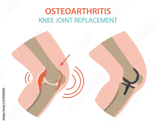 Arthritis, osteoarthritis medical infographic design. Joint replacement, implantant. photo