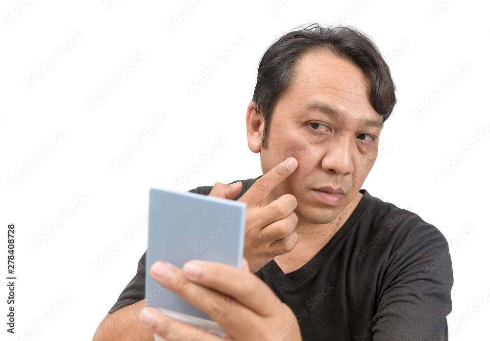 Man applying cream onto face with melasma Man applying cream onto face with melasma